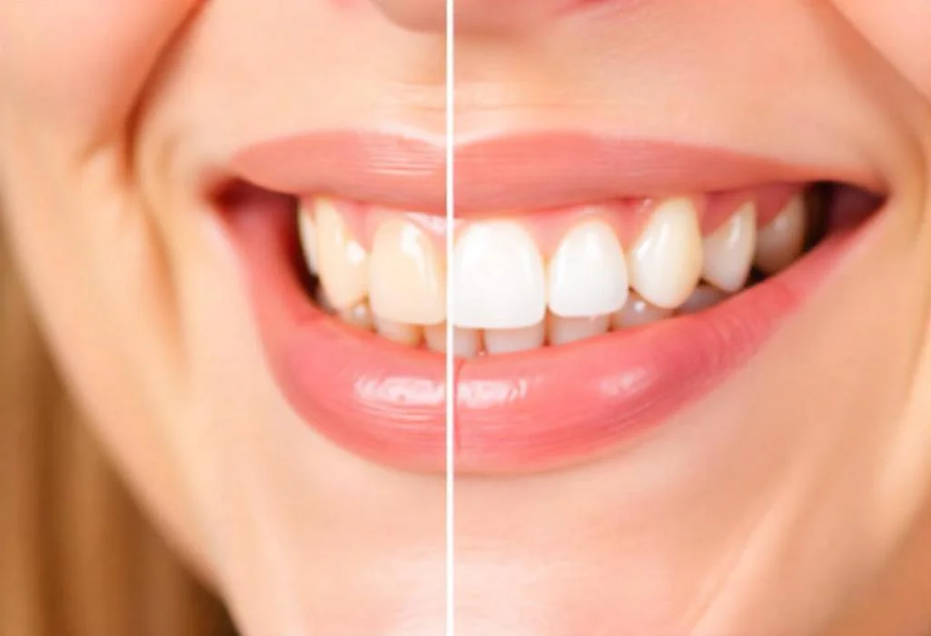 Frågor och svar om tandblekning.